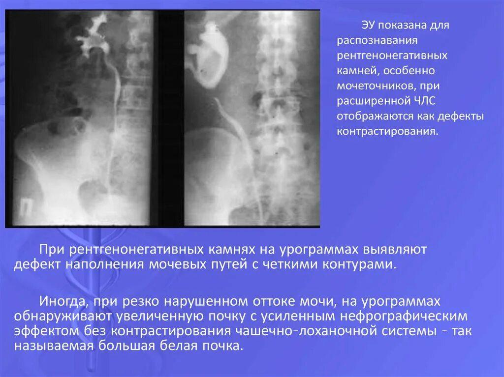 Расширенная чашечно лоханочная система. Рентгенонегативные конкременты почек кт. Рентгенопозитивные и рентгенонегативные камни. Дефект наполнения при рентгенографии почек. Рентгенонегативные камни в мочеточнике.