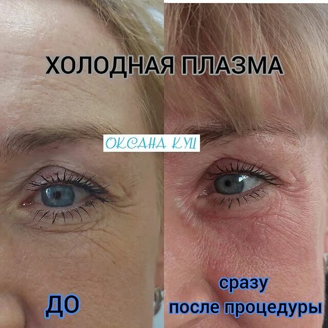 холодная плазма отзывы форум. нитевой лифтинг до и после. холодная плазма отзывы форум. холодный плазма лифтинг для лица. омоложение холодной плазмой.