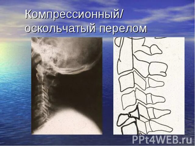 Компрессионный перелом l4. Компрессионный перелом l1 l2 позвонков. Компрессионно оскольчатый перелом позвоночника. Компрессионный перелом позвоночника l1 операции. Компрессионный перелом тела 1 1