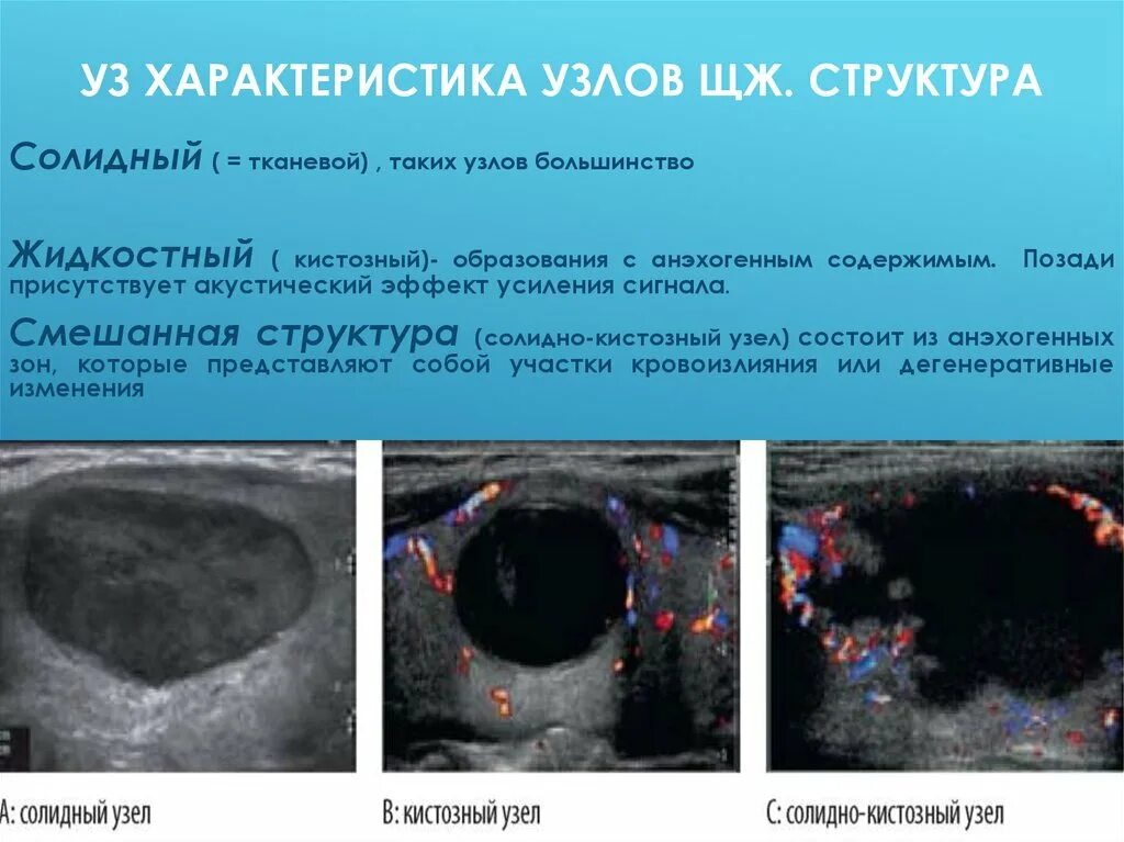 Солидное образование щитовидной железы по УЗИ. Солидное образование в щитовидной железе что это. Солидная структура узла щитовидной железы. Солидный узел в щитовидной железе. Образование перешейка щитовидной железы