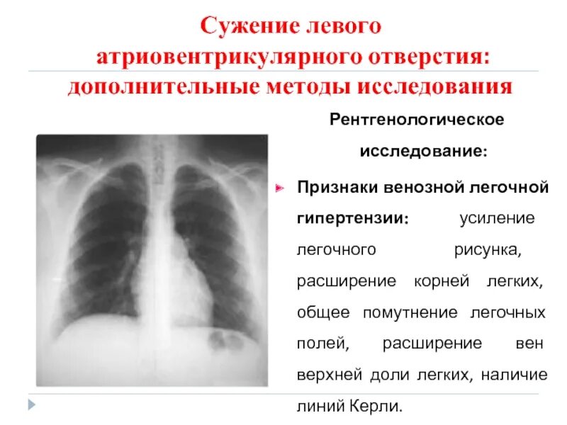 Усиление легочного рисунка. Легочный рисунок усилен. Усиленный легочный рисунок. Симптом изменения легочного рисунка. Что значит легкие расширены