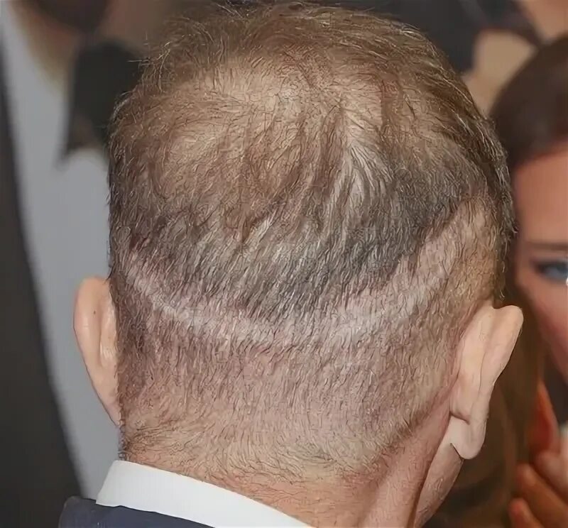 Стас михайлов пересадка волос до и после Hair Transplant Info: What Patients Need to Know Call 1-310-318-1500