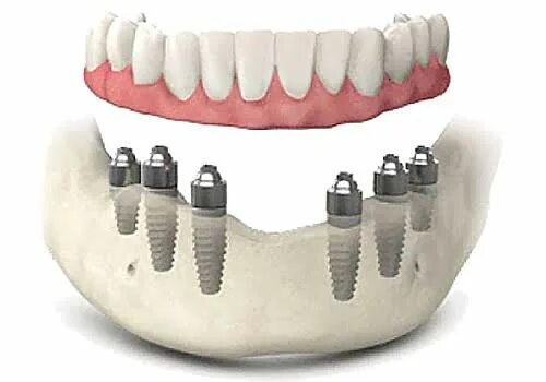 All on 6 цена. Протез на 6ти имплантах. Несъёмный протез на 6 импланта х.