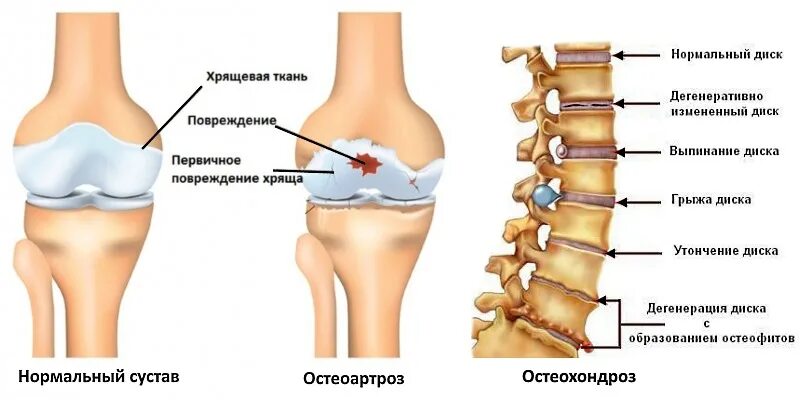 Артрит и артроз разница. Остеохондроз остеопороз остеоартроз. Остеоартроз остеоартрит остеохондроз. Остеоартроз сегмента с1-с2. Остеохондрозом и остеоартрозом.