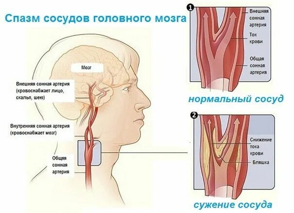 Как снять спазм без лекарств Как снять мышечный спазм что делать при спазмах мышц, чем быстро убрать симпто