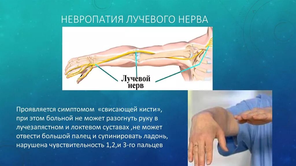 клинические проявления нейропатии лучевого нерва. признаками поражения лучевого нерва являются:. поражение лучевого нерва свисающая кисть. лечение лучевого нерва. лучевой нерв с6.
