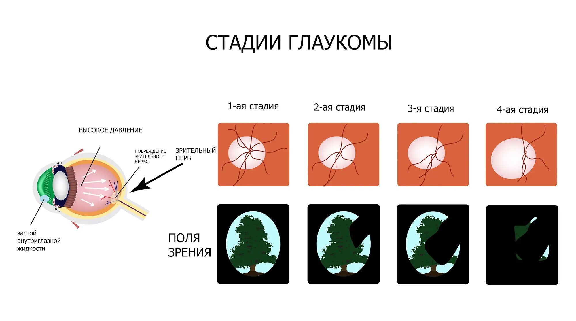 Можно вернуть зрение при глаукоме. Стадии первичной глаукомы. Открытоугольная глаукома классификация. Этапы развития глаукомы. Стадии открытоугольной глаукомы.