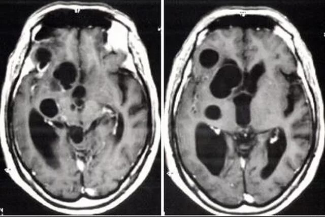Чем опасна киста в мозгу. Ретроцеребеллярная киста на кт. Ретроцеребеллярная ликворная киста мрт. Ретроцеребеллярная арахноидальная киста в головном мозге мрт. Арахноидальная киста головного мозга мрт.