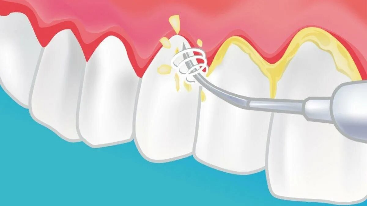 Можно греть зуб. Ультразвуковая чистка зубов. Поддесневой зубной камень. Снятие зубных отложений ультразвуком.