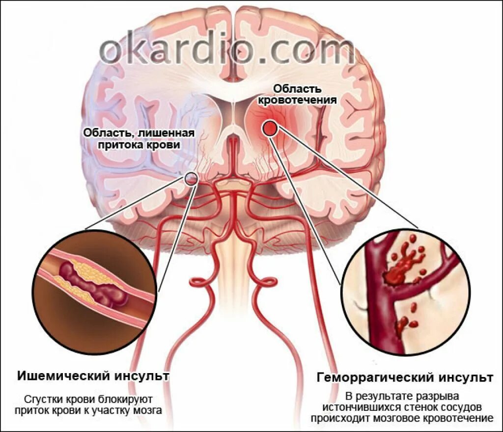Кровоизлияние ствола мозга. Субарахноидальный геморрагического инсульта симптомы. Субарахноидальное кровоизлияние разрыв аневризмы. Разрыв сосуда головного мозга геморрагический инсульт. Геморрагический инсульт это что такое геморрагический инсульт.