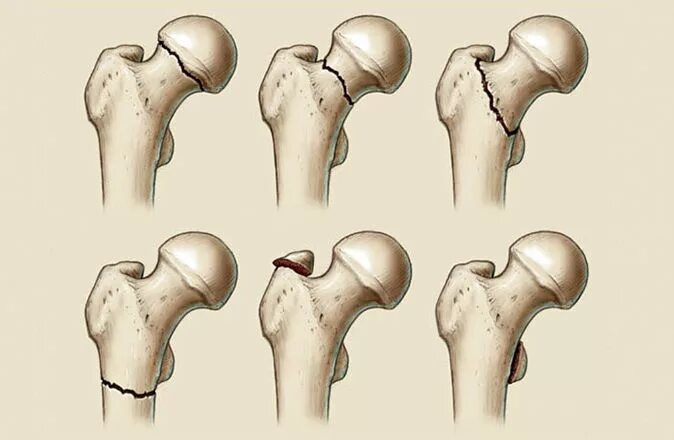 Трещина шейки бедра. Внесуставные переломы шейки бедра. Перелом шейки бедренной кости. Подвертельный перелом бедра. Субкапитальные переломы шейки бедренной кости.