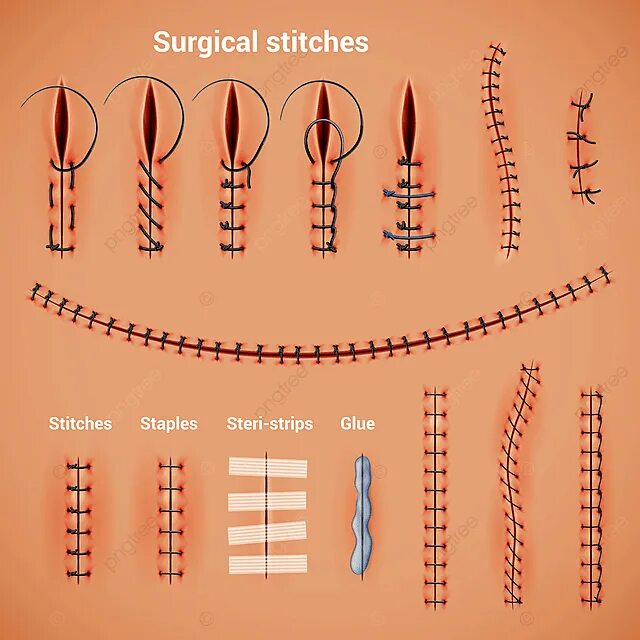 Техника наложения хирургических швов