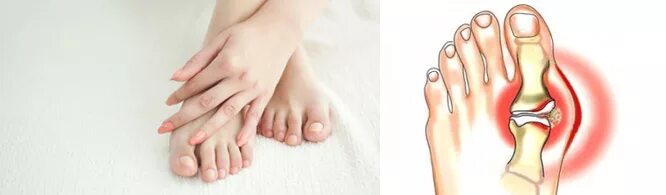 Экзостоз ногтевой фаланги 1 пальца стопы. Подагрический артрит или вальгусная деформации. Небольшая косточка на ноге.