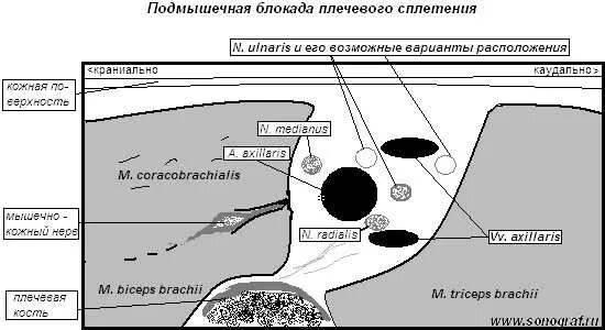 Блокада сплетения. Блокада плечевого сплетения под УЗИ. Это блокада нерва под УЗИ контролем. Подмышечная блокада плечевого сплетения. Блокада подмышечного сплетения.