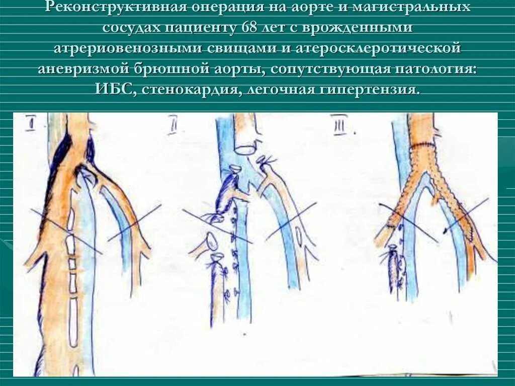 Операция на сосудах цена