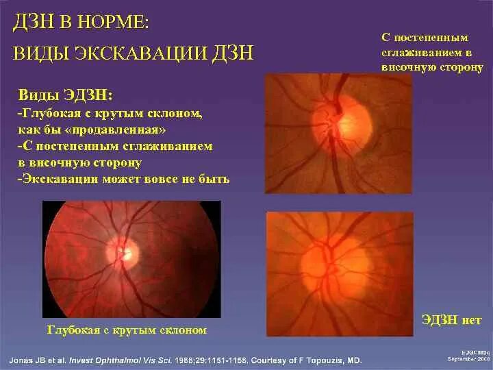 Тип зрительного нерва. Глаукомная экскавация зрительного нерва. Диск зрительного нерва при гиперметропии. Экскавация диска зрительного нерва окт. Э/Д зрительного нерва нормы.