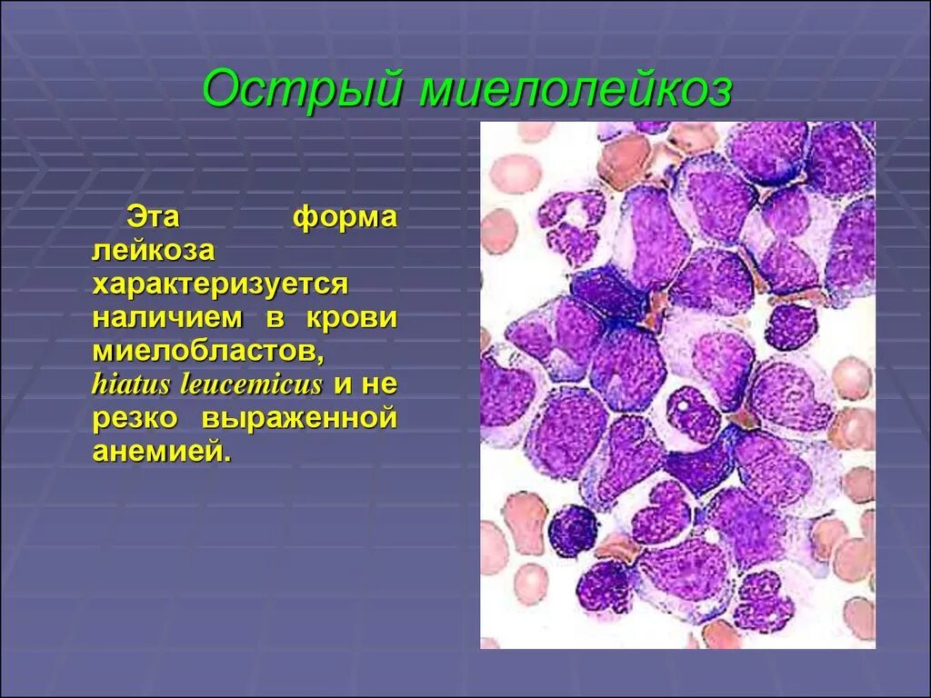 Острый миелобластный лейкоз. Острый миелобластный лейкоз (ОМЛ). Острый миелобластный лейкоз картина крови. Острый моноблпстеый лейкоз.