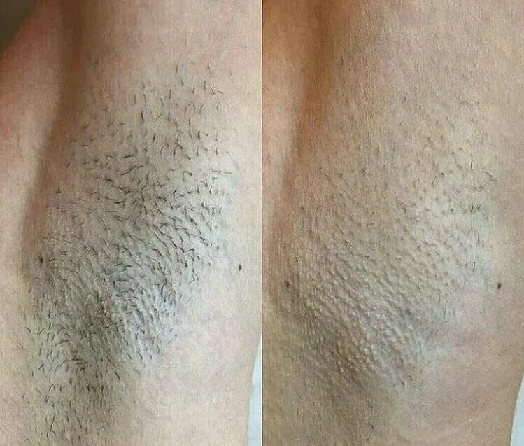 Лазерная эпиляция эффект. Диодная лазерная эпиляция до и после. Депиляция подмышек. Результаты после эпиляции. Электроэпиляция до после подмышки.