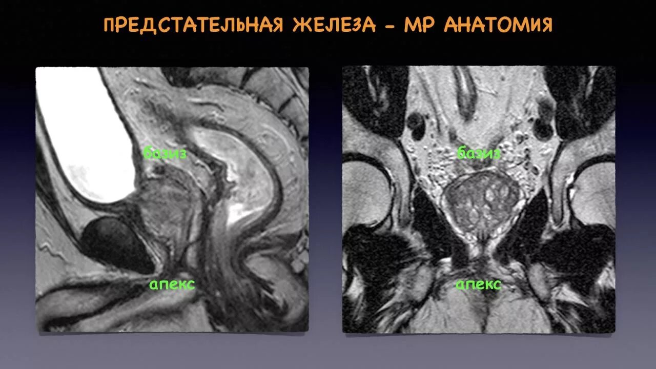 Аденома простаты мрт. Зональная анатомия предстательной железы мрт. Мрт предстательной железы по Pi rads. Аденокарцинома предстательной железы мрт. Парапростатическая клетчатка мрт.