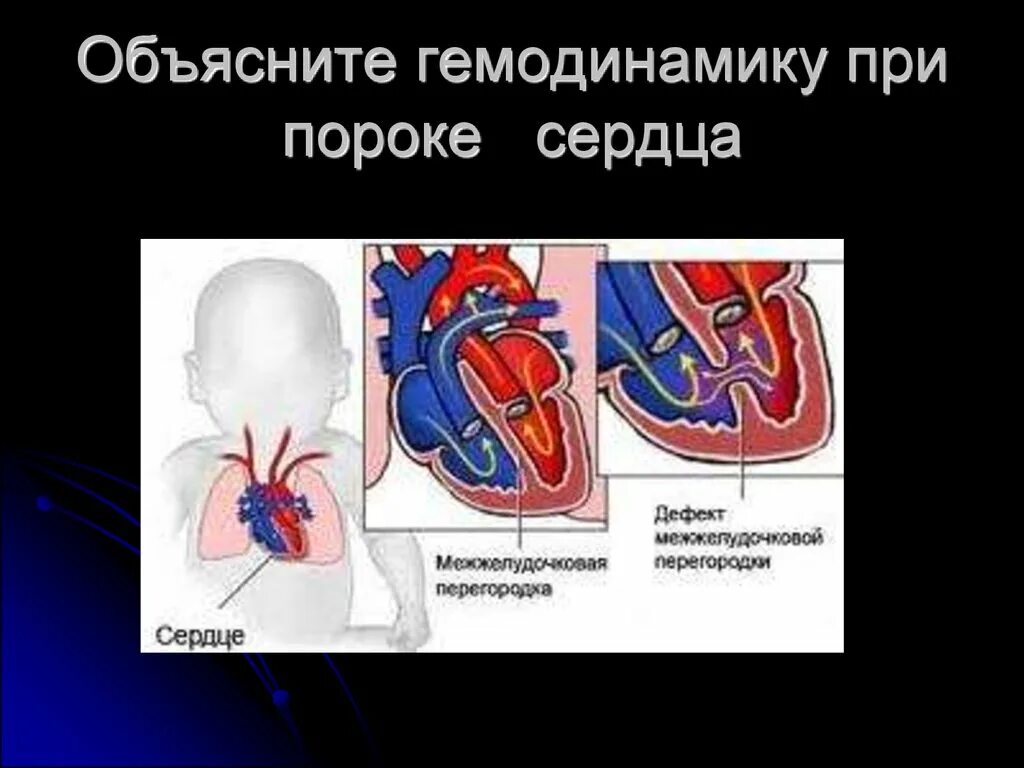 Нарушение внутрисердечной гемодинамики