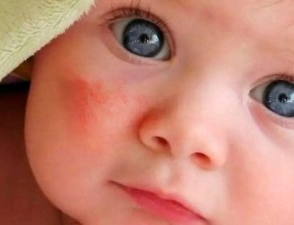 сильно красные щеки у ребенка