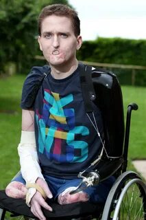 Британец, потерявший из-за инфекции обе ноги и руку 