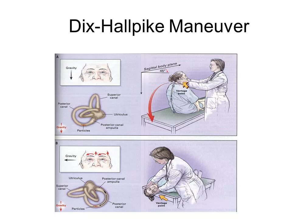 Проба холпайка. ДППГ проба Дикса Холлпайка. Dix Hallpike. Dix Hallpike maneuver. Тест Дикса-Холлпайка.