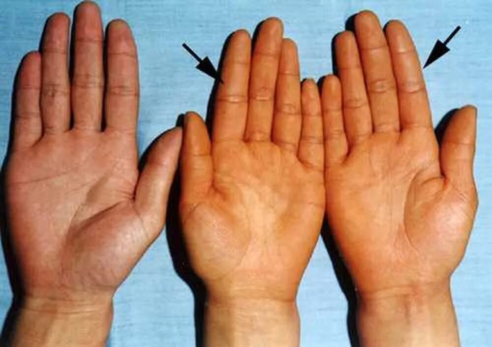 Пальмарная эритререма. Иктеричность кожных покровов. Почему желтеют руки причина