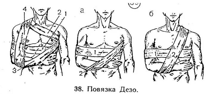 Схема наложения повязки Дезо. Наложение повязки Дезо алгоритм. Повязка Дезо техника. Повязка Дезо техника наложения.