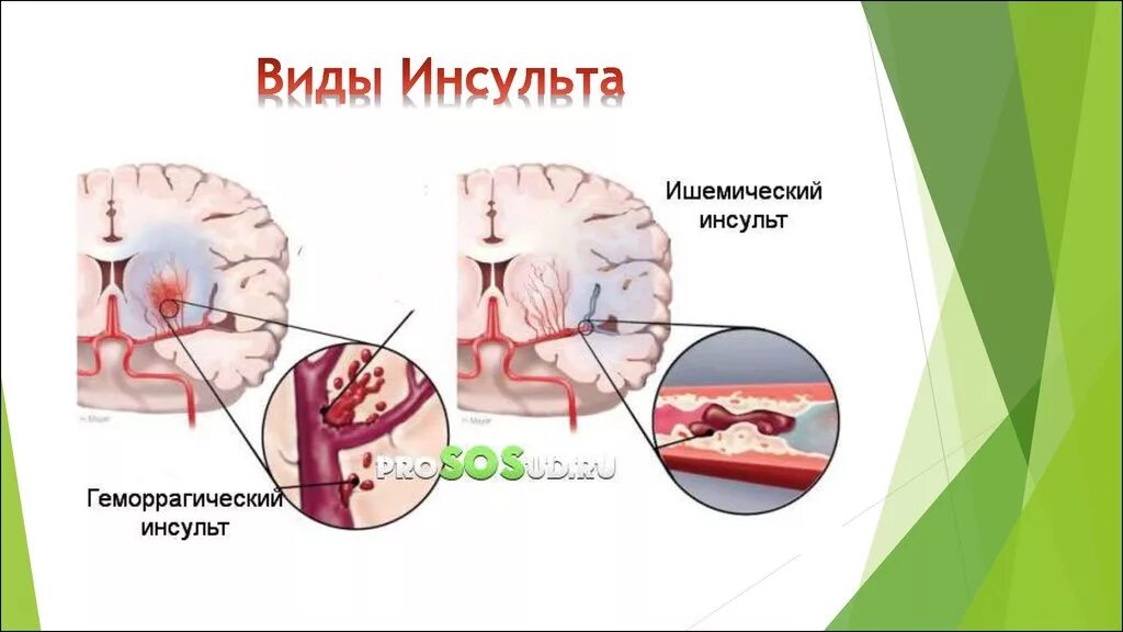 Инсульт органа. Инсульт. Виды инсульта. Инсульт типы инсульта.