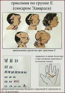 Трисомия что это значит