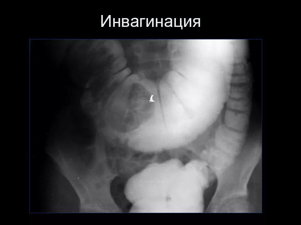 Уровень на рентгене. Уровень на рентгене