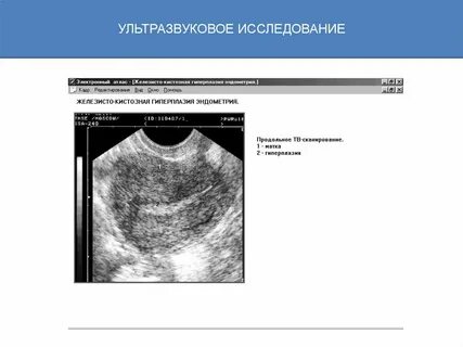 Эндометрия на узи
