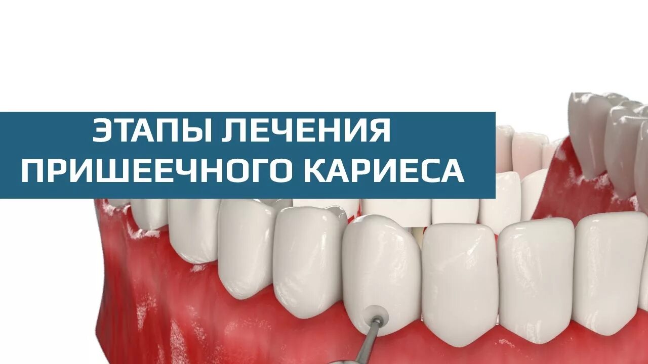 Лечение пришеечного кариеса по доступным ценам в Москве Стоматологический компле
