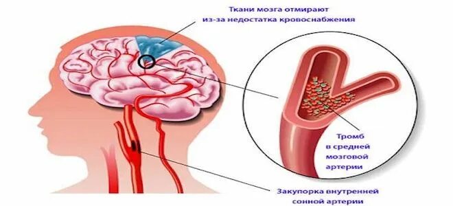 Ангиодистония сосудов. Осложнения атеросклероза артерий головного мозга. Осложнения атеросклероза сосудов головного мозга. Атеросклеротическое поражение магистральных артерий головы. Осложнения атеросклероза сосудов.