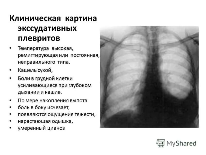 Кашель и тяжесть в грудной клетке