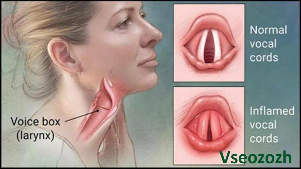 Как восстановить голосовые связки. Хронический узелковый ларингит. Воспаленные голосовые связки.