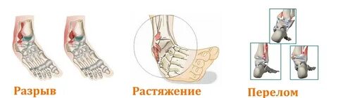 Болят ноги в голеностопе причины