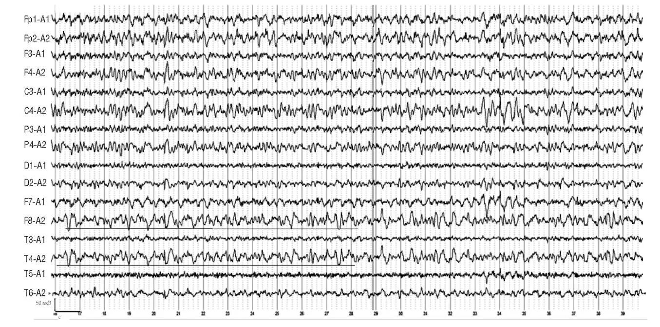 Ээг минск. Асимметрия на ЭЭГ. Межполушарная асимметрия на ЭЭГ. Деменция ЭЭГ. Межполушарная асимметрия отсутствует на ЭЭГ.