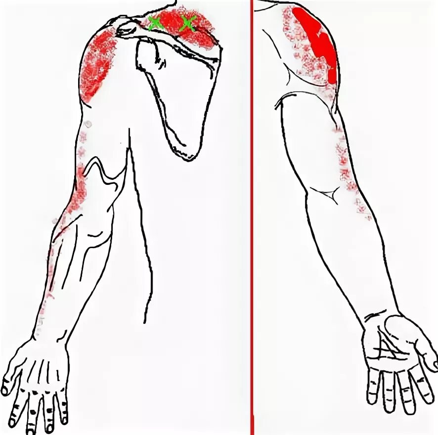 Больно левую руку. Миофасциальный синдром плеча. Миофасциальный болевой синдром триггерные точки. Миофасциальный синдром руки. Миофасциальный синдром кисти.