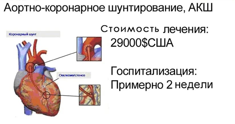 Что такое шунтирование сердца и сосудов