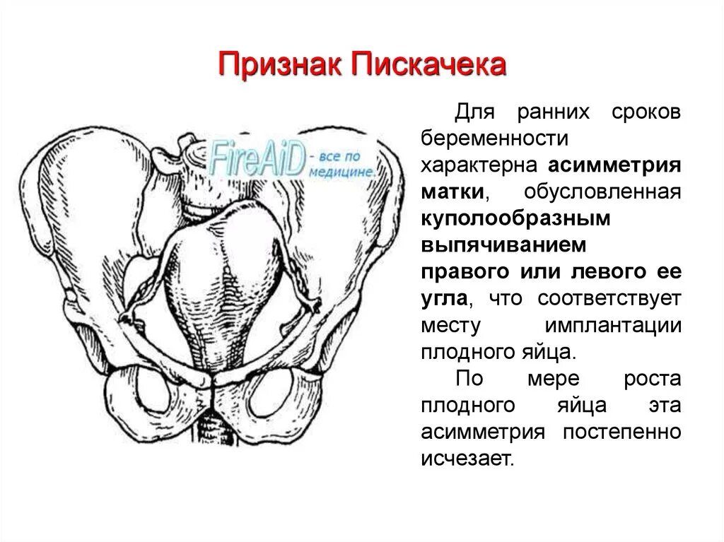 Признак пискачека. Признак Пискачека и Снегирева. Признаки диагностики беременности пескачекп. Симптомы Пискачека Гентера. Метод Пискачека в акушерстве.