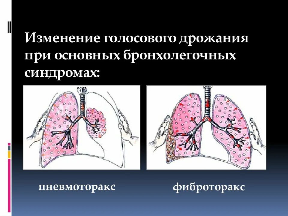 Фиброторакс шварты. Фиброторакс синдром. Голосовое дрожание при основных бронхолегочный синдромах. Шварты в легких это