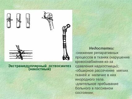 Остеосинтез противопоказания