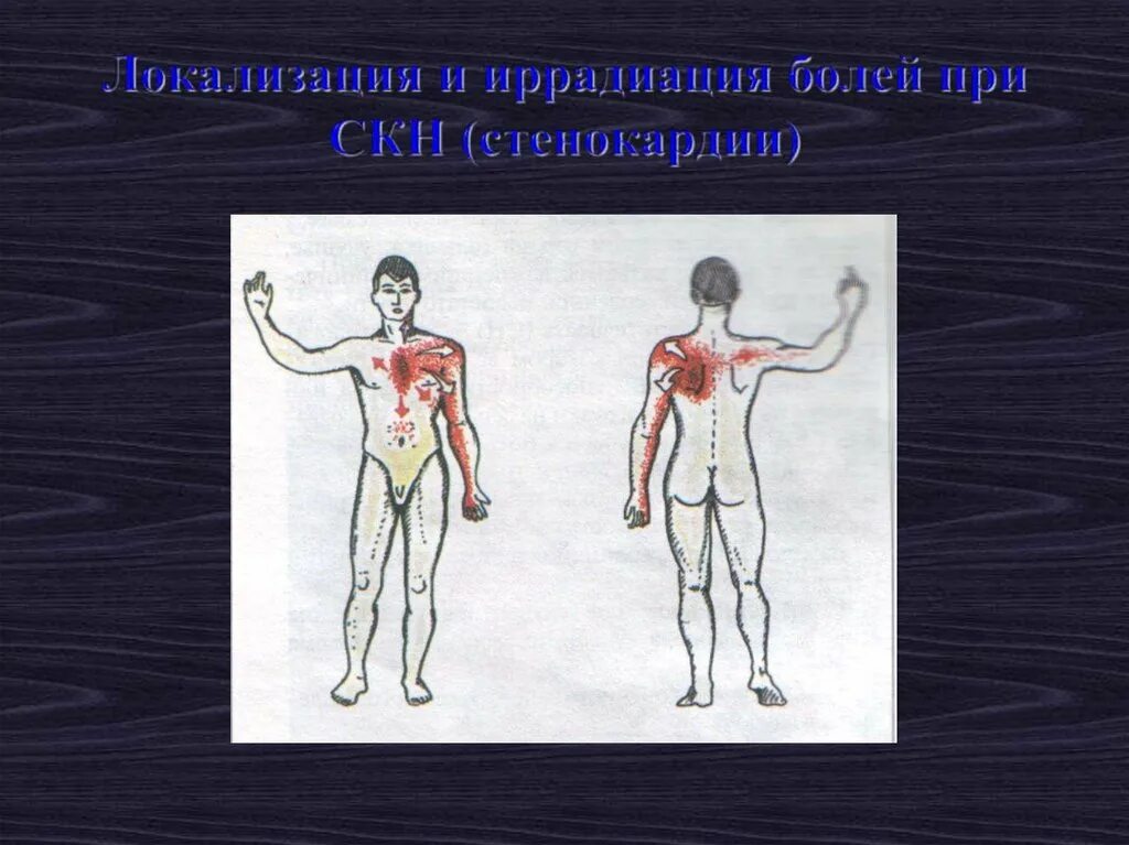 Иррадиация стенокардии. Локализация боли при стенокардии. Иррадиация боли при стенокардии. Локализация и иррадиация боли при стенокардии.