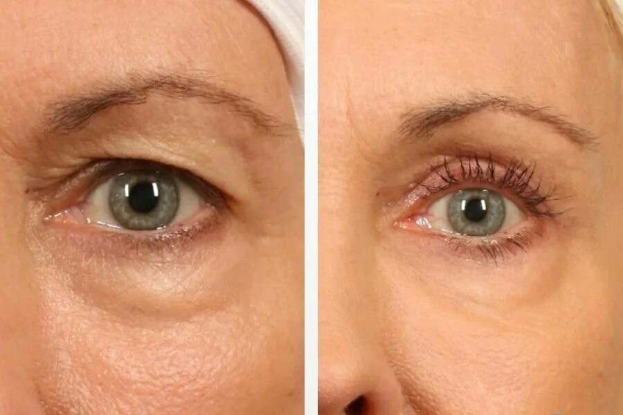 Dermaheal eyebag solution от мешков под глазами. Мезо под глаза дермахил. Блефаропластика (пластика нижних век). Блефаропластика нависших век. Нависшее веко как избавиться в домашних