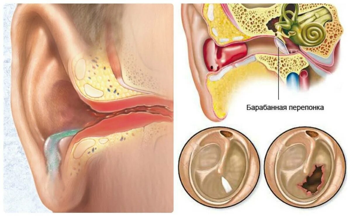 Острый Гнойный средний отит барабанная перепонка. Гнойный отит барабанная перепонка. Причины воспаления среднего уха