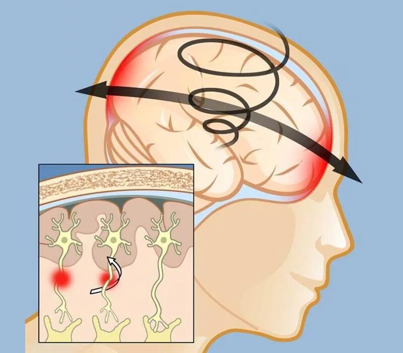 Импульсная травма головы это. Травма- сотрясение головного мозга. Сотрясение симптомы и лечение