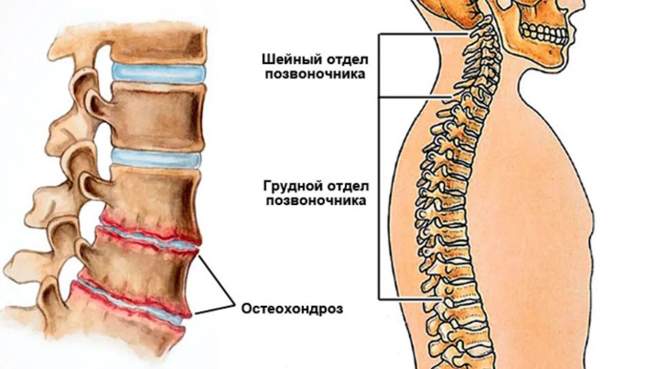 Найдите грудной отдел позвоночника обратите. Остеохондроз th6-th11. Остеохондроз среднегрудного отдела позвоночника. Строение позвоночника остеохондроз. Остеохондроз шейного позвонка отдела позвоночника.