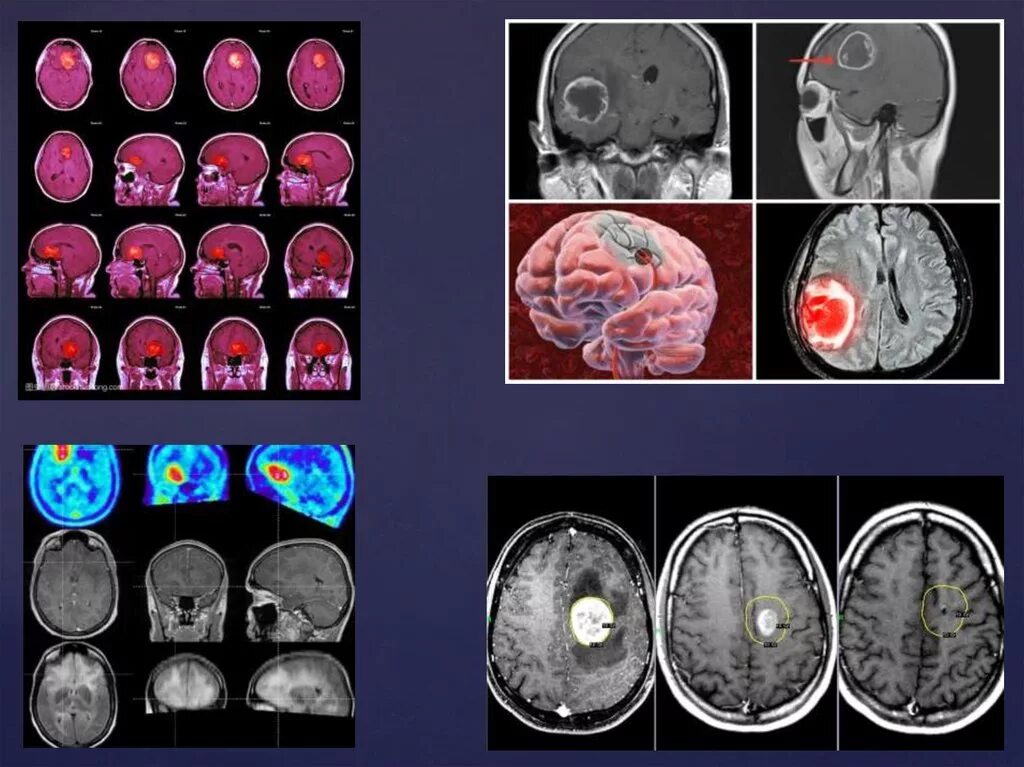Неоперабельная глиобластома. Доброкачественная глиобластома. Опухоль мозга глиобластома. Глиобластома метастазы. Опухоль головного мозга отек